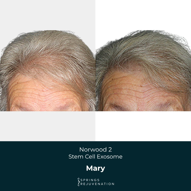 Norwood 2 Stem Cell Exosome - Mary